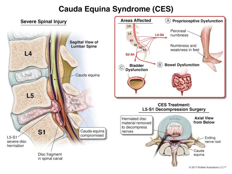 Cauda Equina Syndrome Cmg Law 9895