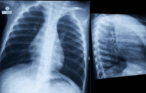 spinal compression misdiagnosis attorney in seattle washington